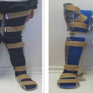 درمان پای ضربدری در مشهد درمان پای ضربدری کودکان در مشهد